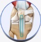 ACL Reconstruction Patellar Tendon