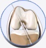 Anterior Cruciate Ligament ACL Reconstruction