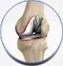 Revision Knee Replacement