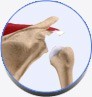 Shoulder Instability 