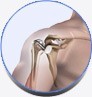 Shoulder Joint Replacement