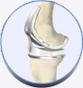 Total Knee Replacement