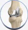 Uni Condylar Knee Replacement